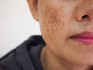 Close-up of a woman's face showing melasma, with dark brown patches of pigmentation
