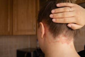 Red, scaly patches of skin on the back of a woman’s neck and scalp, showing symptoms of scalp psoriasis