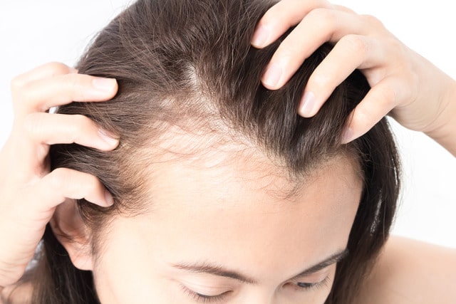 Woman showing thinning hair at hairline