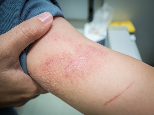 Close-up of a red, irritated rash on a person’s arm, showing contact dermatitis symptoms like dryness, scaling, and inflammation.